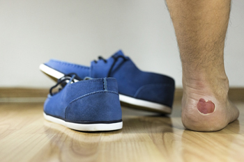 Preventing blisters deals