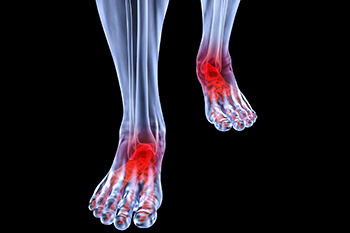 Arthritic foot and ankle care treatment, foot arthritis treatment in the Queens County, NY: Flushing (College Point, Whitestone, Elmhurst, Jackson Heights, Jamaica, Forest Hills, Astoria, Corona), Nassau County, NY: Elmont, Floral Park, Great Neck, Lake Success and Bergen County, NJ: Fort Lee (Englewood, Tenafly, Teaneck, Teterboro, Hackensack, Bergenfield, East Rutherford, Paramus), Hudson County, NJ: Secaucus, Hoboken areas