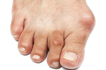 Bunions treatment and surgery in the Queens County, NY: Flushing (College Point, Whitestone, Elmhurst, Jackson Heights, Jamaica, Forest Hills, Astoria, Corona), Nassau County, NY: Elmont, Floral Park, Great Neck, Lake Success and Bergen County, NJ: Fort Lee (Englewood, Tenafly, Teaneck, Teterboro, Hackensack, Bergenfield, East Rutherford, Paramus), Hudson County, NJ: Secaucus, Hoboken areas