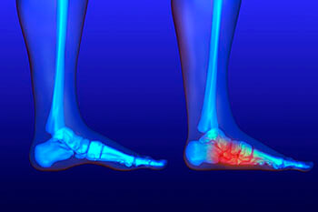 Flat feet and Fallen Arches treatment, Flatfoot Deformity Treatment in the Queens County, NY: Flushing (College Point, Whitestone, Elmhurst, Jackson Heights, Jamaica, Forest Hills, Astoria, Corona), Nassau County, NY: Elmont, Floral Park, Great Neck, Lake Success and Bergen County, NJ: Fort Lee (Englewood, Tenafly, Teaneck, Teterboro, Hackensack, Bergenfield, East Rutherford, Paramus), Hudson County, NJ: Secaucus, Hoboken areas