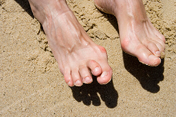 Hammertoes & Mallet Toes treatment in the Queens County, NY: Flushing (College Point, Whitestone, Elmhurst, Jackson Heights, Jamaica, Forest Hills, Astoria, Corona), Nassau County, NY: Elmont, Floral Park, Great Neck, Lake Success and Bergen County, NJ: Fort Lee (Englewood, Tenafly, Teaneck, Teterboro, Hackensack, Bergenfield, East Rutherford, Paramus), Hudson County, NJ: Secaucus, Hoboken areas