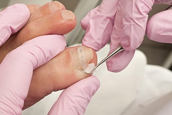 Ingrown toenails treatment in the Queens County, NY: Flushing (College Point, Whitestone, Elmhurst, Jackson Heights, Jamaica, Forest Hills, Astoria, Corona), Nassau County, NY: Elmont, Floral Park, Great Neck, Lake Success and Bergen County, NJ: Fort Lee (Englewood, Tenafly, Teaneck, Teterboro, Hackensack, Bergenfield, East Rutherford, Paramus), Hudson County, NJ: Secaucus, Hoboken areas