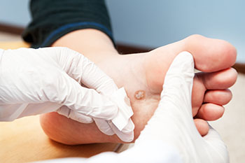 Plantar warts specialist in the Queens County, NY: Flushing (College Point, Whitestone, Elmhurst, Jackson Heights, Jamaica, Forest Hills, Astoria, Corona), Nassau County, NY: Elmont, Floral Park, Great Neck, Lake Success and Bergen County, NJ: Fort Lee (Englewood, Tenafly, Teaneck, Teterboro, Hackensack, Bergenfield, East Rutherford, Paramus), Hudson County, NJ: Secaucus, Hoboken areas
